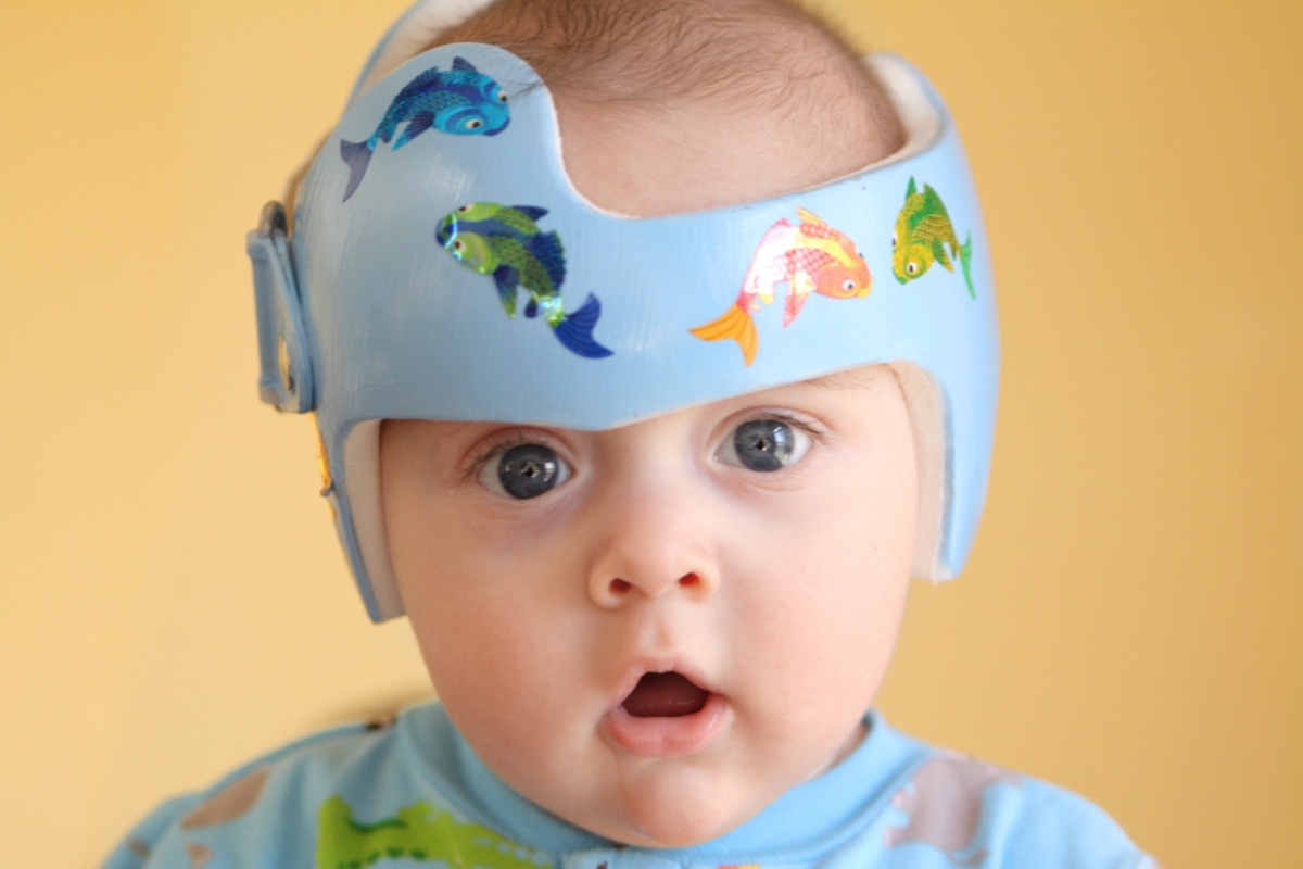 Why do babies with store down syndrome wear helmets