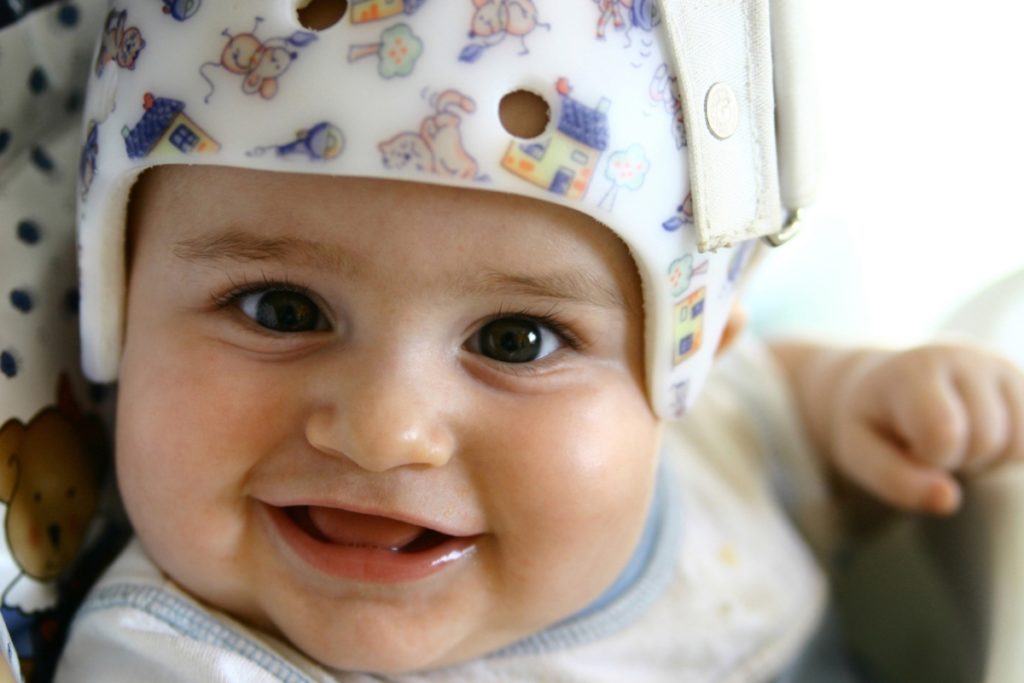 Why Do Babies Wear Helmets?